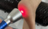 Laser Therapy: High-Intensity Treatment That Works