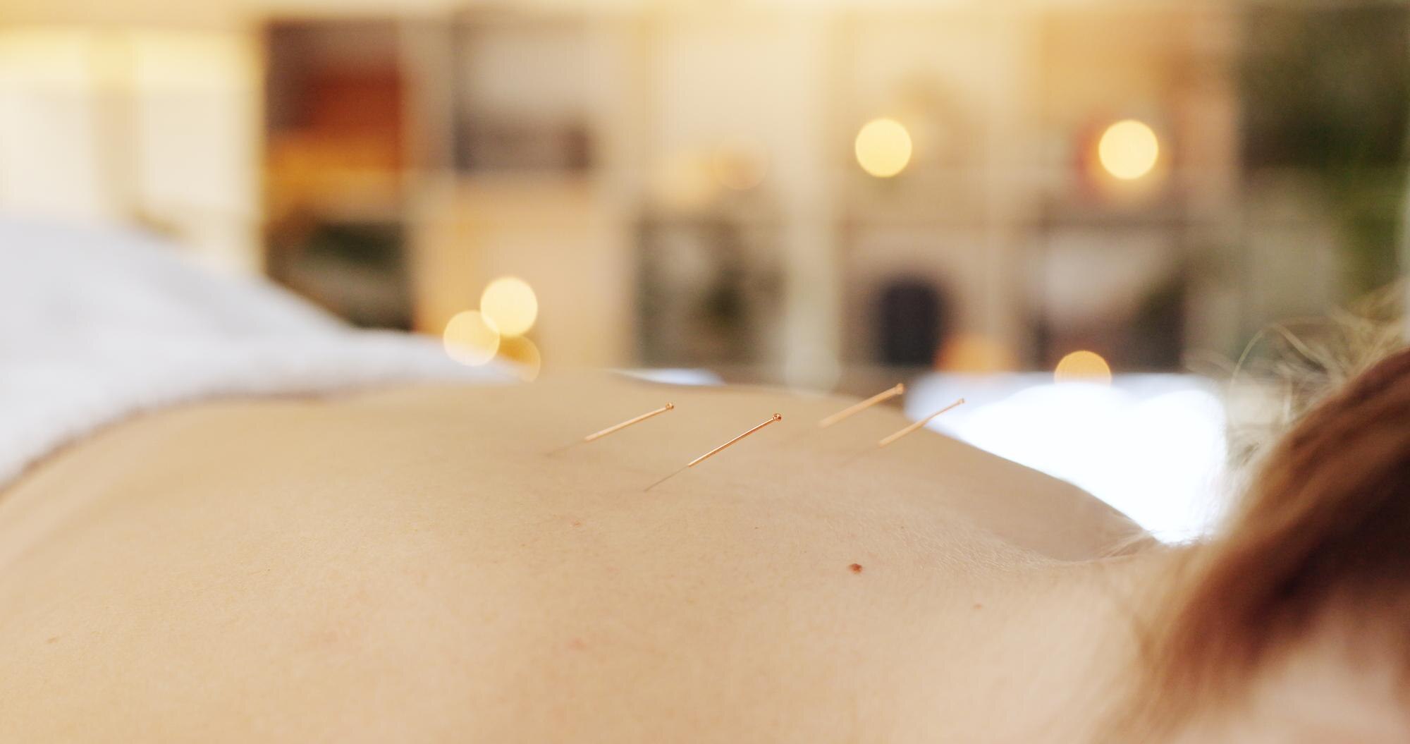Acupuncture for Pain Relief
