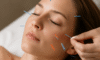 Cosmetic Acupuncture: Important Disadvantages to Note