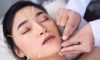 Cosmetic Acupuncture: Important Drawbacks to Know
